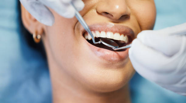 Best Emergency Dentist for Lost Fillings or Crowns in Mvern, AL