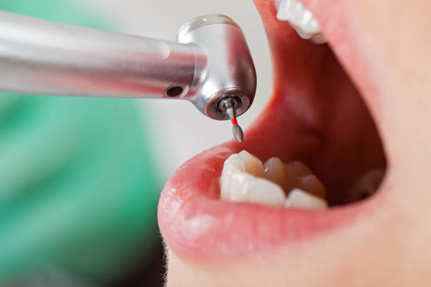 Best Emergency Dentist for Knocked-Out Tooth in Mvern, AL